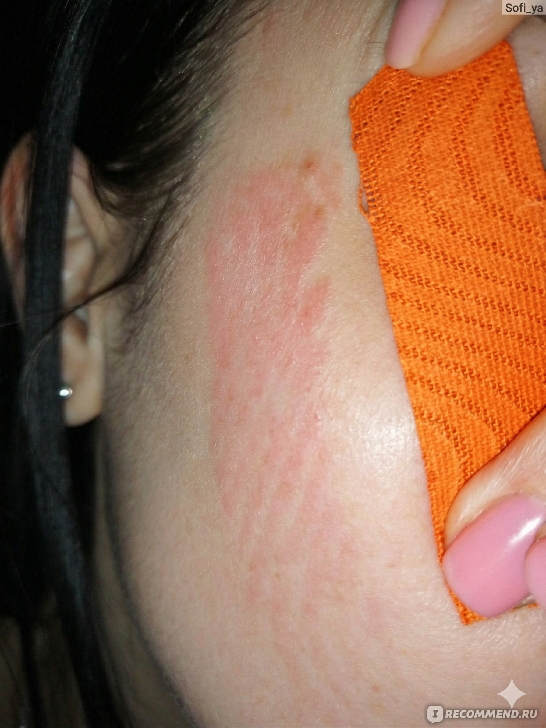 Reaktionen auf Tape: Warum es beim Facetaping und Bodytaping meist keine Allergie ist